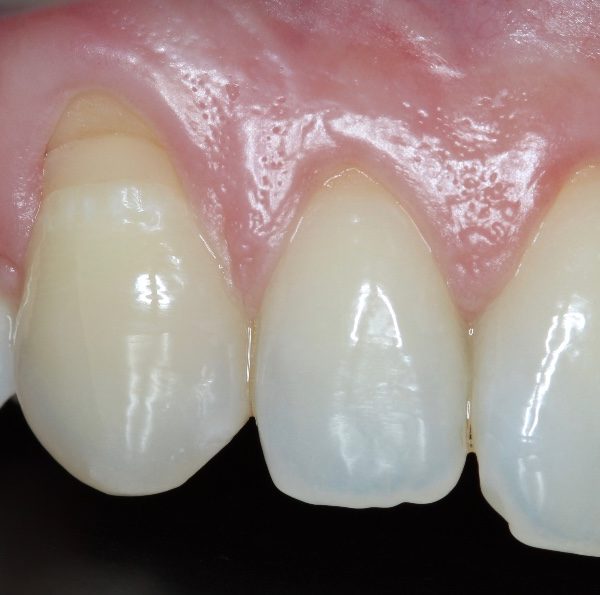 Cirugía mucogingival de recubr …