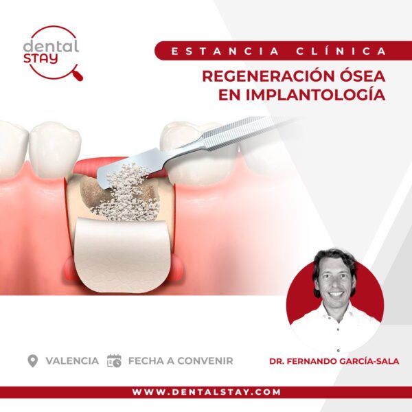 REGENERACIÓN ÓSEA EN IMPLANTO …